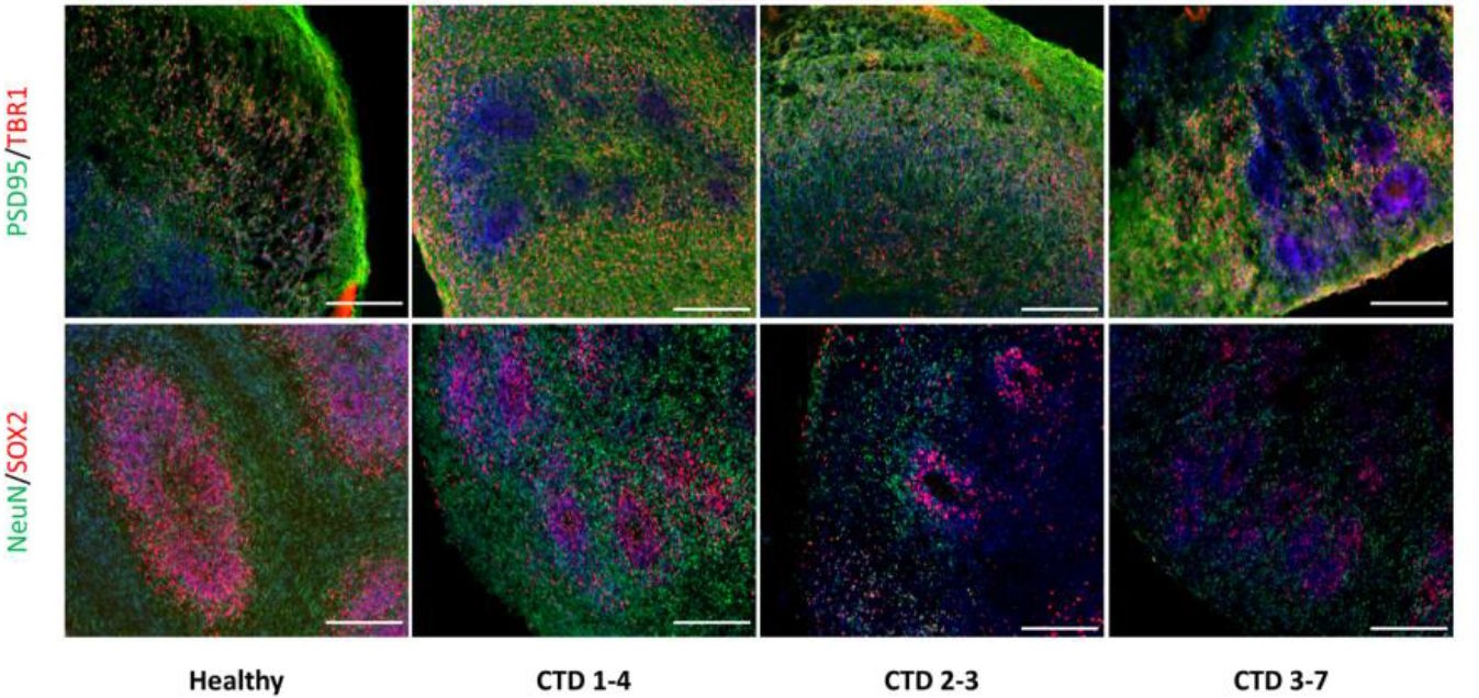 Publication sur un modèle organoïde de déficit neuronal